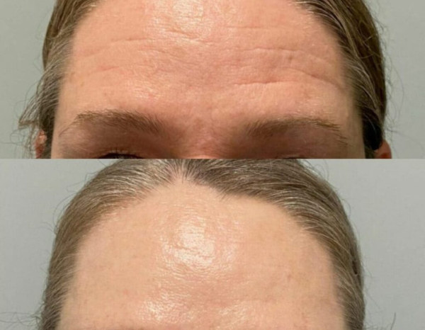 Antes e Depois Linhas