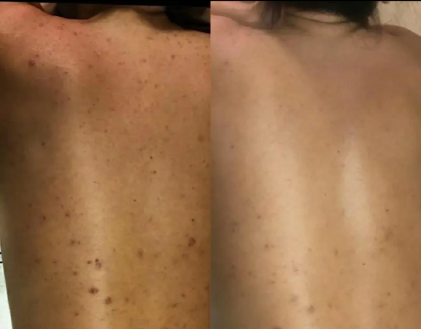 Antes e Depois Acne