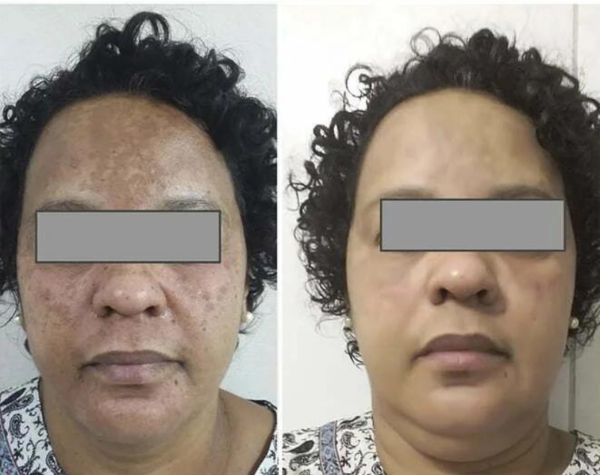 Antes e Depois Melasma